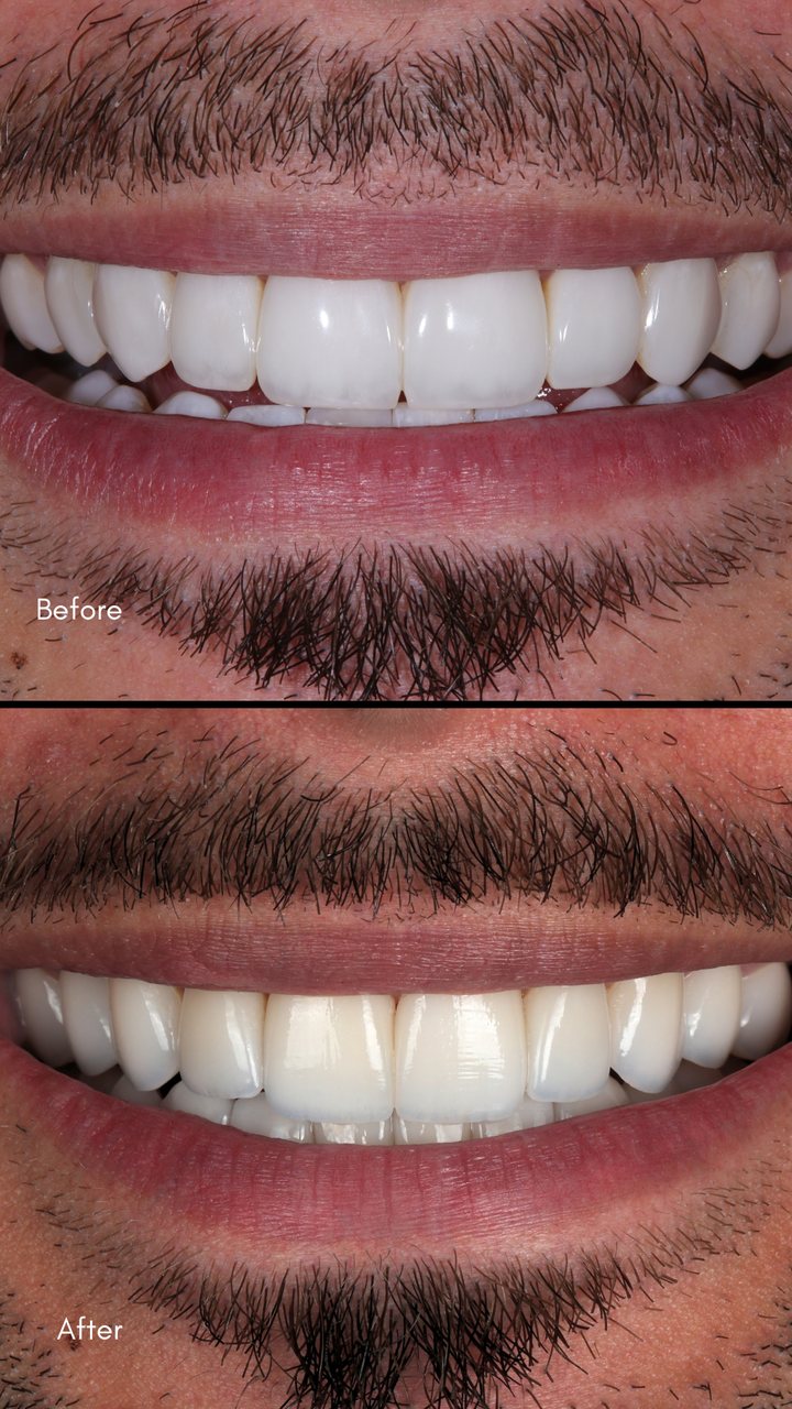 Smile before and after treatment, Las Olas Dentistry patient
