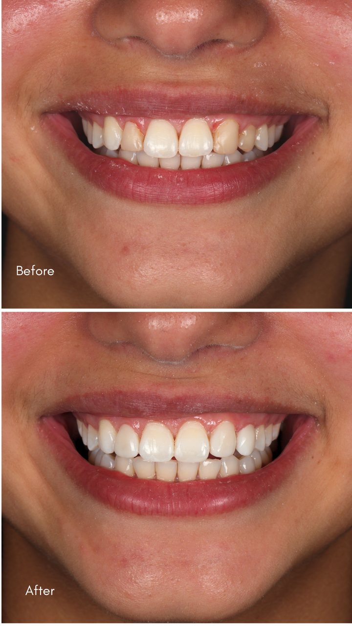 Smile before and after treatment, Las Olas Dentistry patient